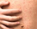Podľa WHO a CDC predstavujú osýpky bezprostrednú hrozbu