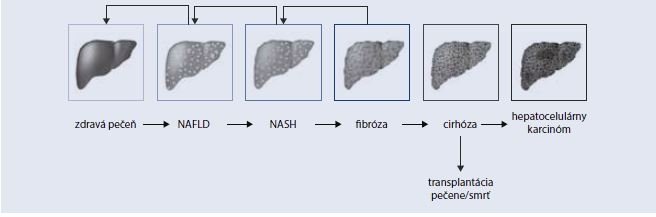 Prirodzený vývoj NAFLD.