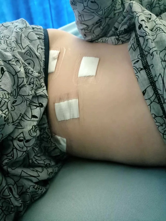 Bobby podstúpil operáciu, ktorá mu zmenila život, krátko predtým, ako sa mu takmer roztrhli črevá.