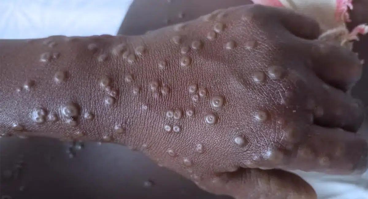 Mpox sa prejavuje kombináciou systémových a kožných symptómov. 