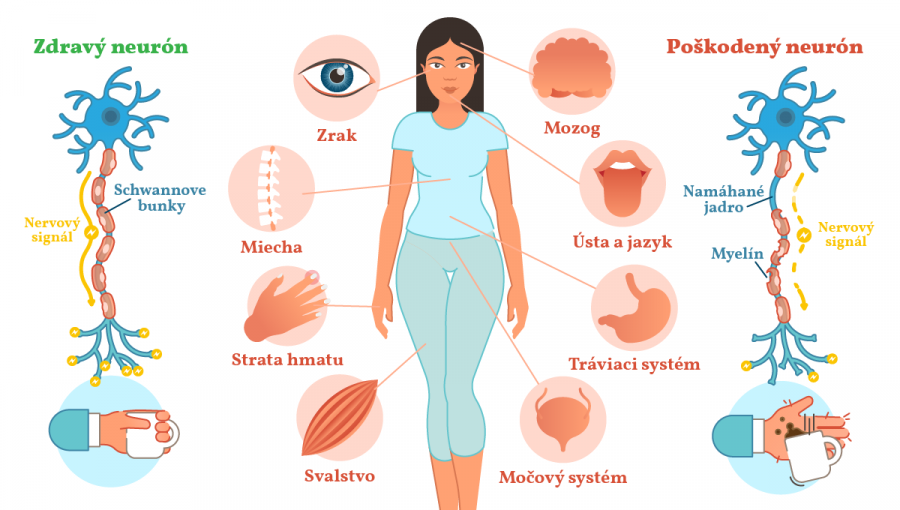 Skleróza multiplex poškodzuje mnohé telesné funkcie. Schwannove bunky (vľavo) zrýchľujú prenos nervového signálu. Myelín (vpravo) tvorí obaly okolo výbežkov nervových buniek. 