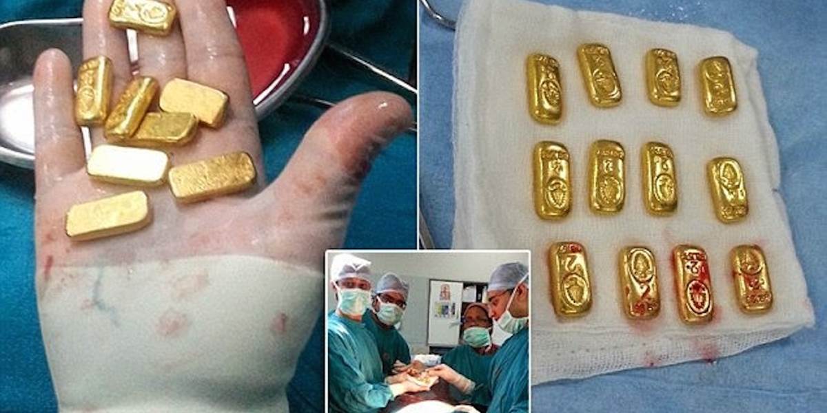 Kuriozita: Lekári vyoperovali pacientovi z brucha 12 zlatých tehličiek!
