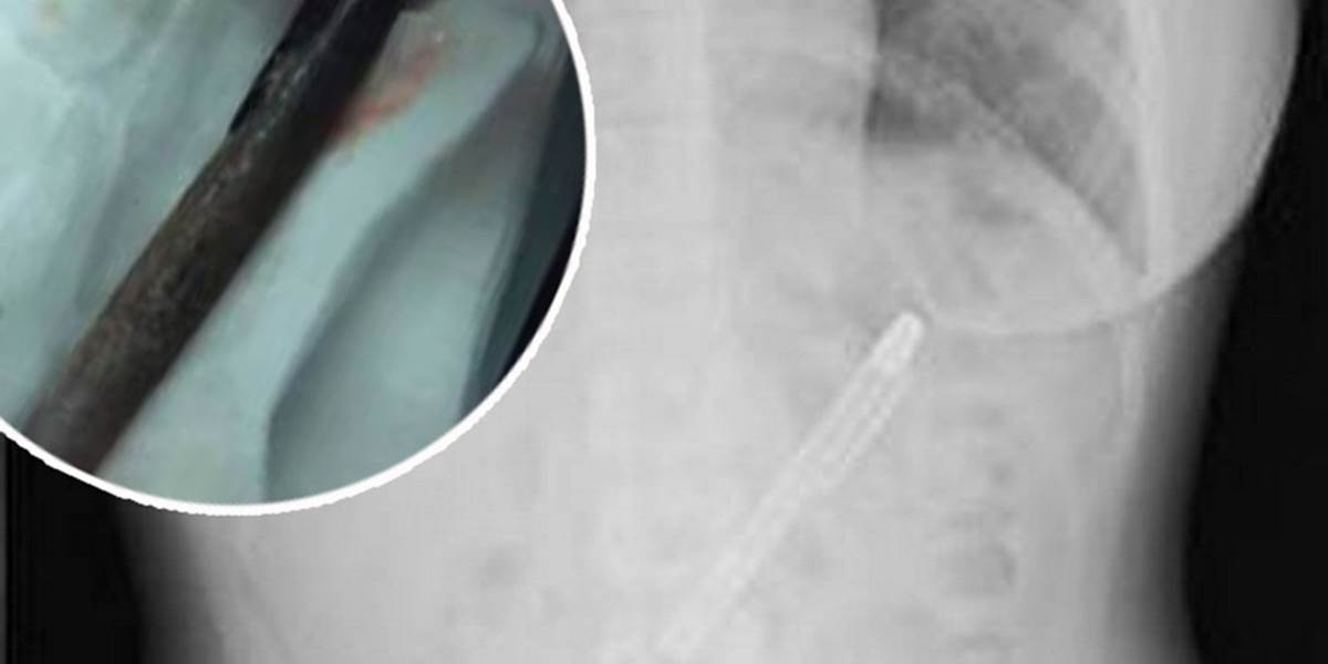 FOTO Žena trpela neznesiteľnými bolesťami, v žalúdku jej našli plniace pero