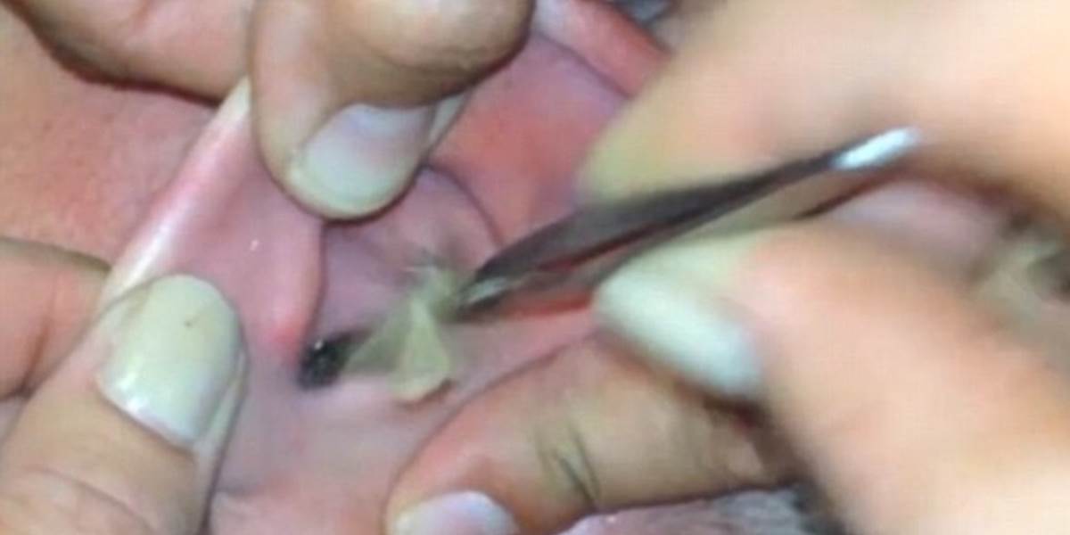 Nechutné VIDEO: Mužovi vytiahli z ucha molu!