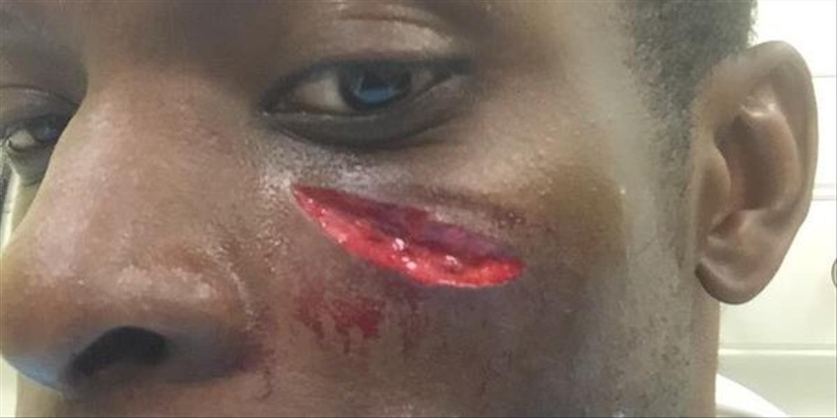 Hororové zranenie tváre obrancu QPR v zápase proti Arsenalu