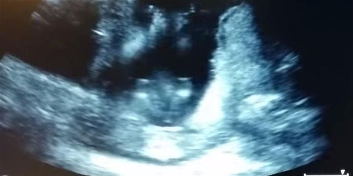 VIDEO Dieťa na ultrazvuku tlieska do rytmu hudby