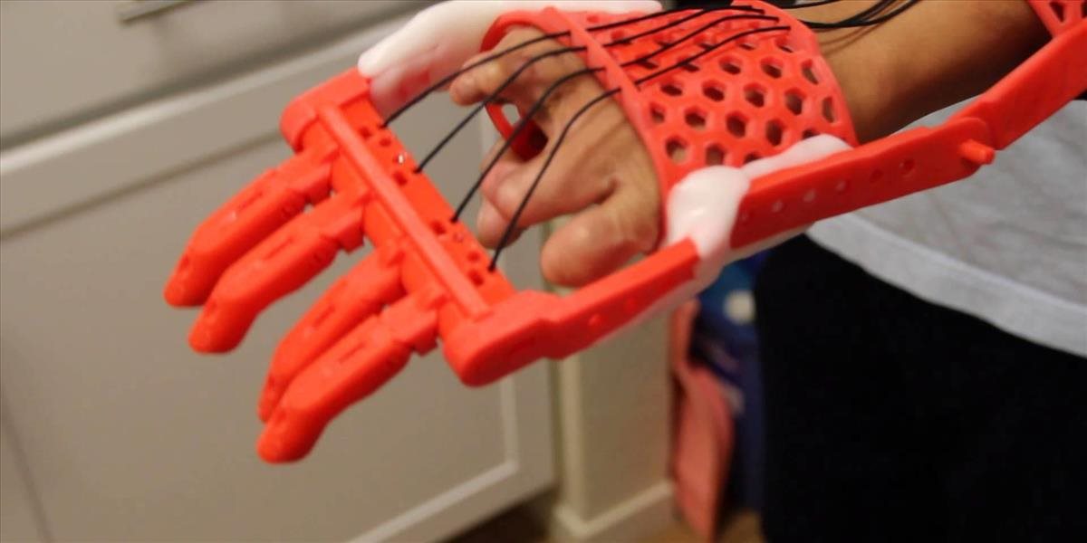 Sedemročná Američanka dostala novú ruku z 3D tlačiarne