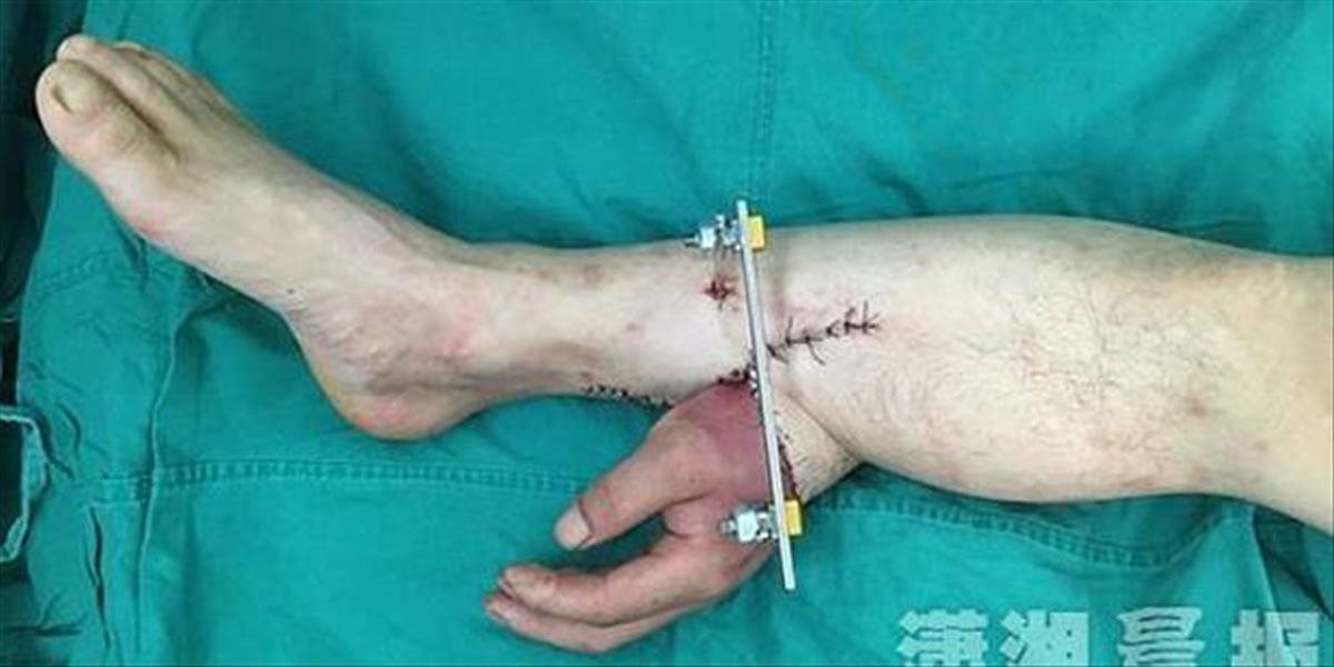 Lekári zachránili mužovi ruku: Prišili ju k nohe, aby ju udržali nažive
