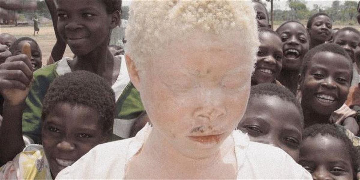 Život albína v Afrike je prekliatie, časti ich tiel používajú pre čarodejnícke praktiky