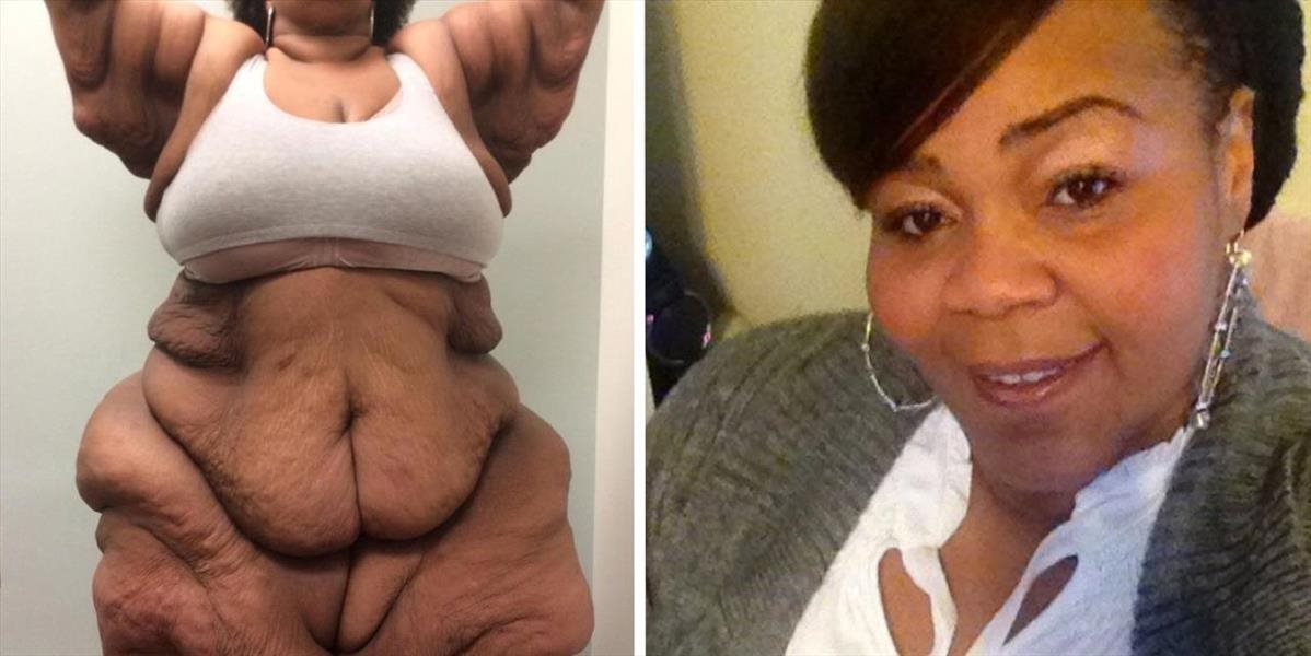 Najťažšia žena na svete schudla: Zhodila 200 kíl!
