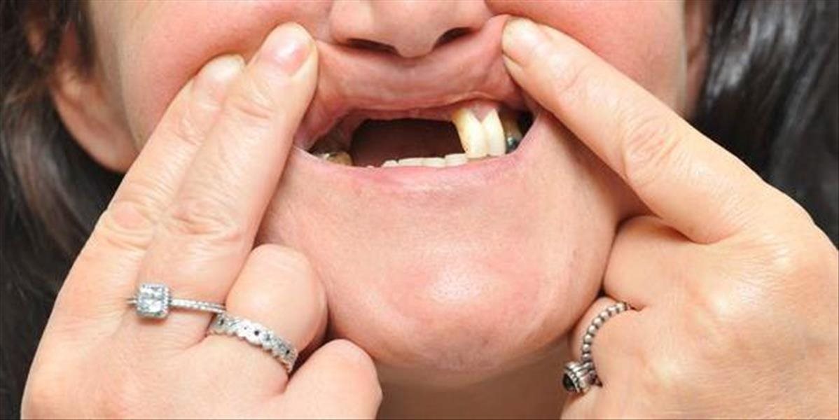 Žena doplatila na márnivosť, falošná zubárka jej peroxidom zničila zuby