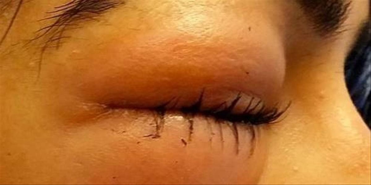Strasti bežného života: Žena pri fúkaní nosa takmer prišla o zrak, tlačila príliš silno