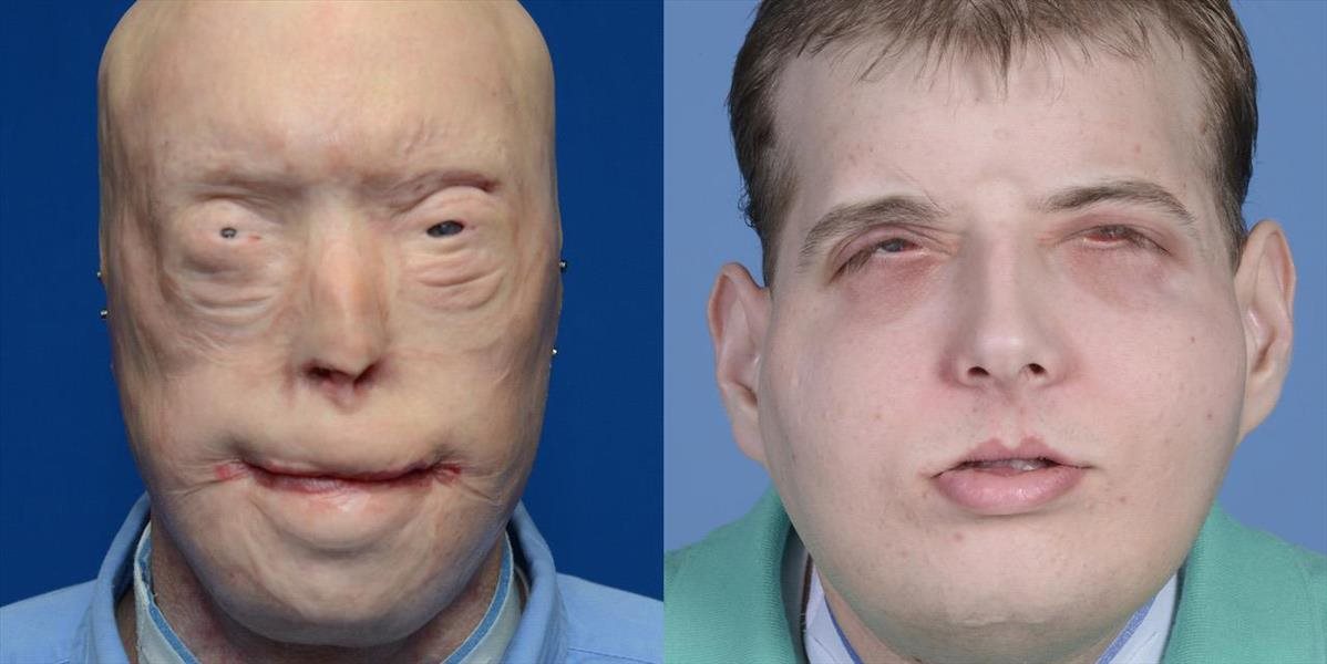 Unikátna transplantácia: Popálený hasič dostal novú tvár