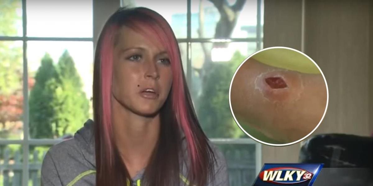 Dievča si dala gumičku na zápästie: Dostala až tri infekcie!