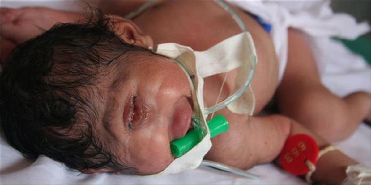 Desivé FOTO: Dieťa sa narodilo s kyklopiou, lekári mu dávajú len pár dní života