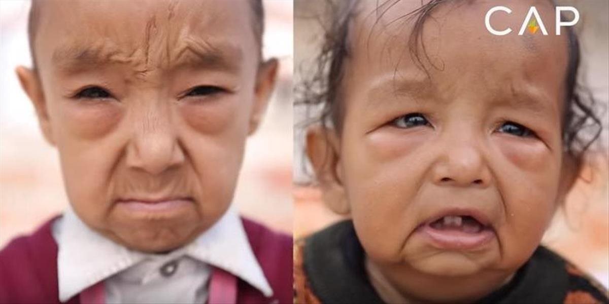FOTO a VIDEO Zákerná choroba trápi indických súrodencov, vyzerajú staršie ako rodičia