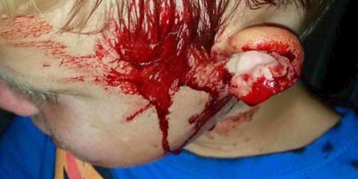 Horor v Austrálii: Malého chlapca v spánku napadol pytón, zahryzol ho do tváre