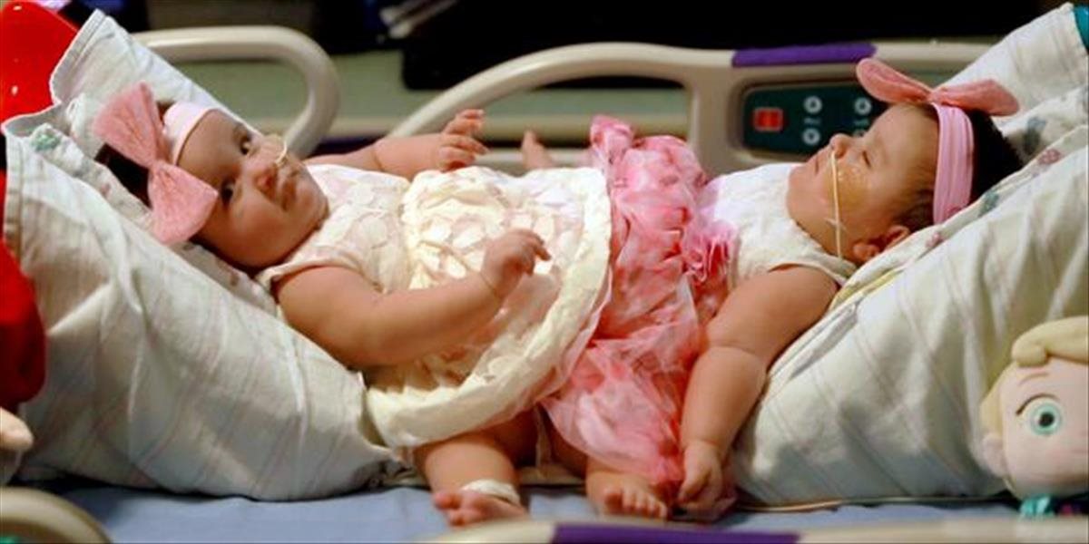 V Texase oddelili siamské dvojičky, ktoré sa narodili ako trojičky