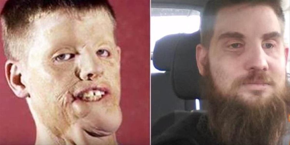 FOTO Hrdinovi, ktorého znetvorilo 10 000 voltov elektriny, transplantovali novú tvár: Vyzeral som ako zombie