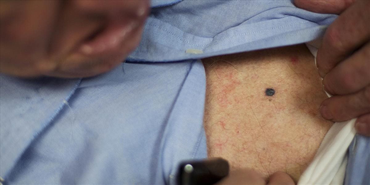 Rakovina kože postihuje čoraz viac ľudí, upozorňujú lekári