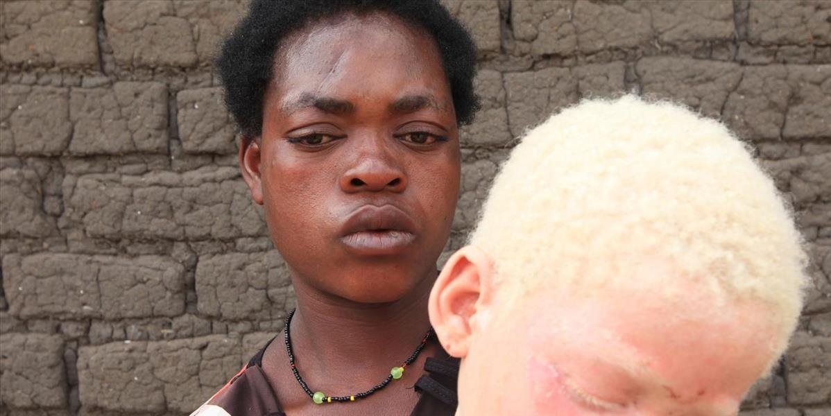 Amnesty International: V Malawi stále vraždia albínov
