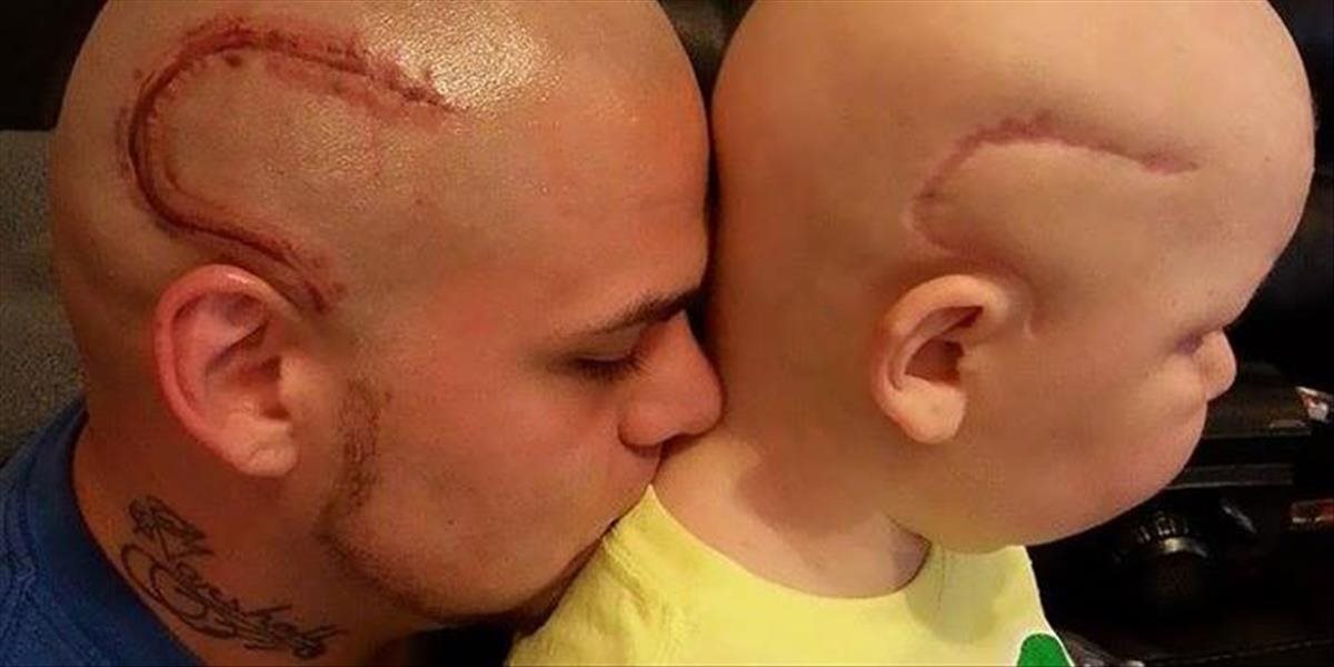 FOTO Dojemný príbeh: Otec si zjazvil hlavu, aby podporil syna, ktorý bojuje s rakovinou mozgu