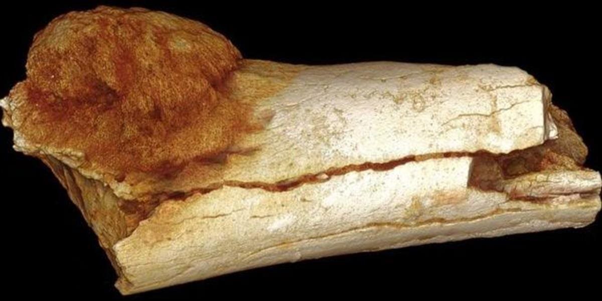 Objavili najstaršie známe dôkazy rakoviny u hominina