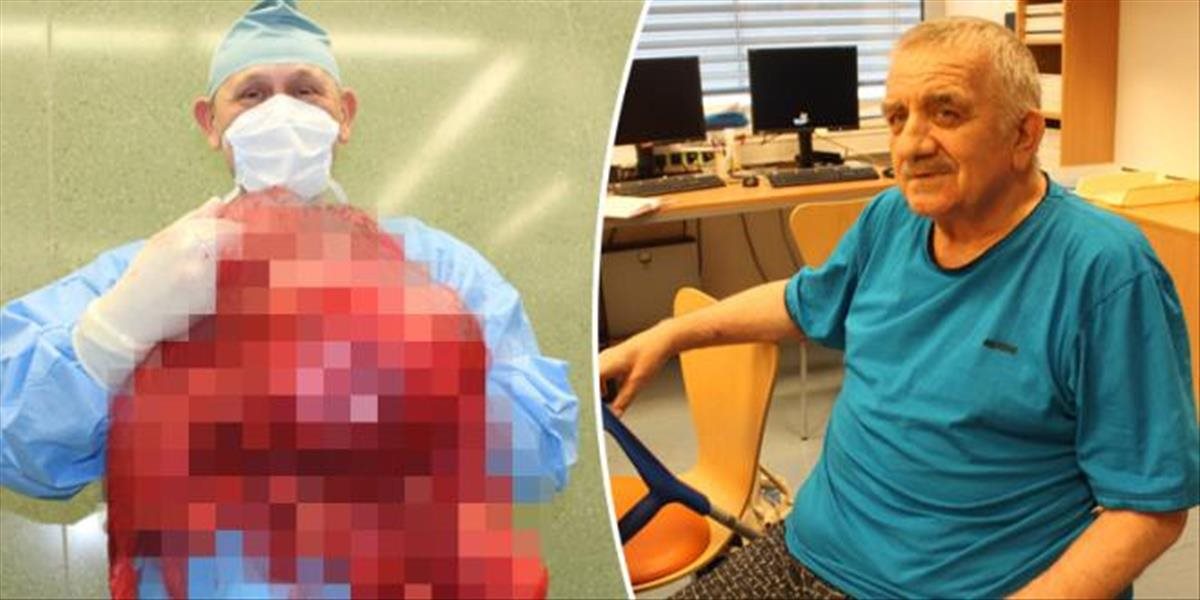 FOTO Muž zo Zlína si myslel, že priberá: V bruchu mal 27 kilogramový nádor!