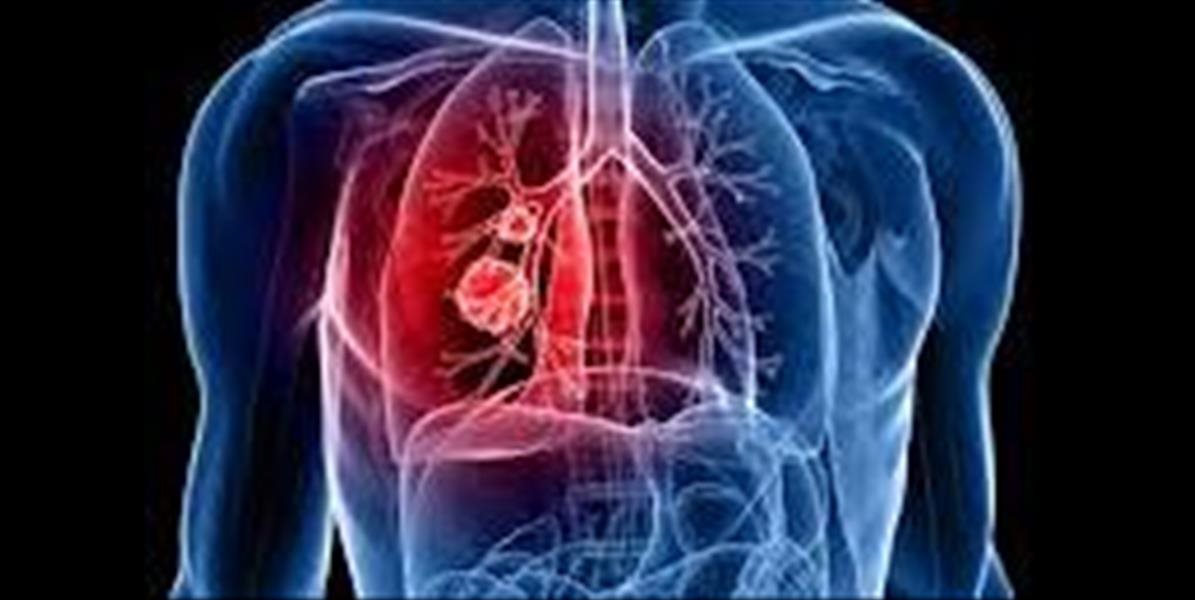 Chronická obštrukčná choroba pľúc trápi každého 10. Slováka, netýka sa len fajčiarov