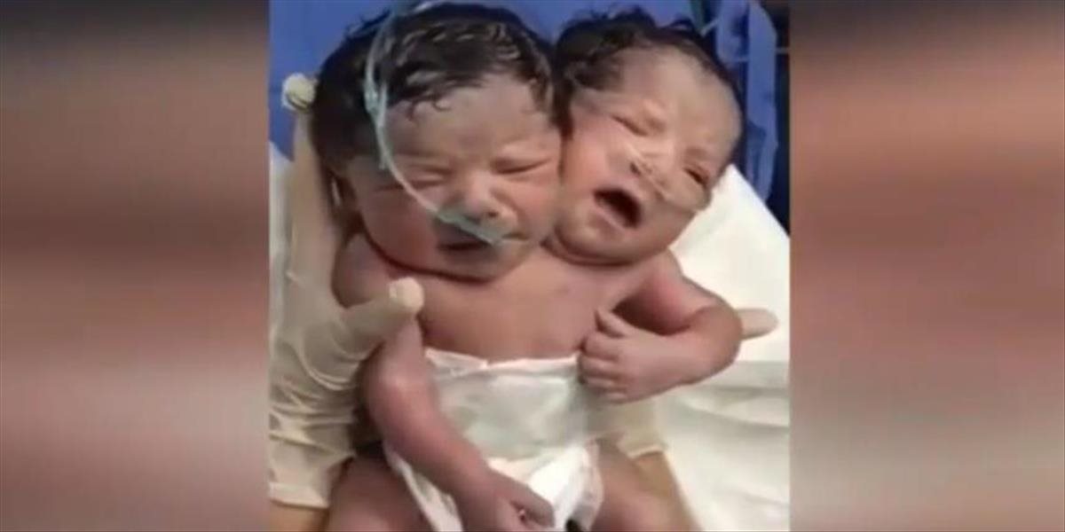 VIDEO V Mexiku sa narodilo dieťa s dvoma hlavami, lekári si lámu hlavu nad jeho budúcnosťou