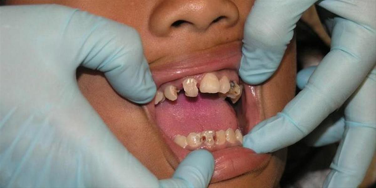 Najčastejším chronickým ochorením detí a mládeže je zubný kaz