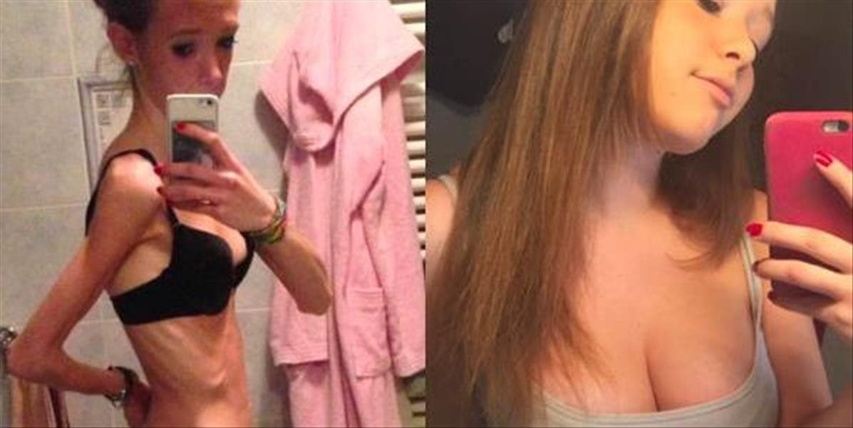 FOTO Neuveriteľné! Mladučká študentka vážila len 34 kíl! Sebazaprením vyhrala boj s anorexiou