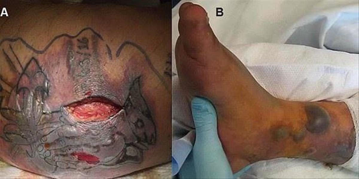Mladý muž zomrel po tom, ako sa išiel kúpať s čerstvým tetovaním