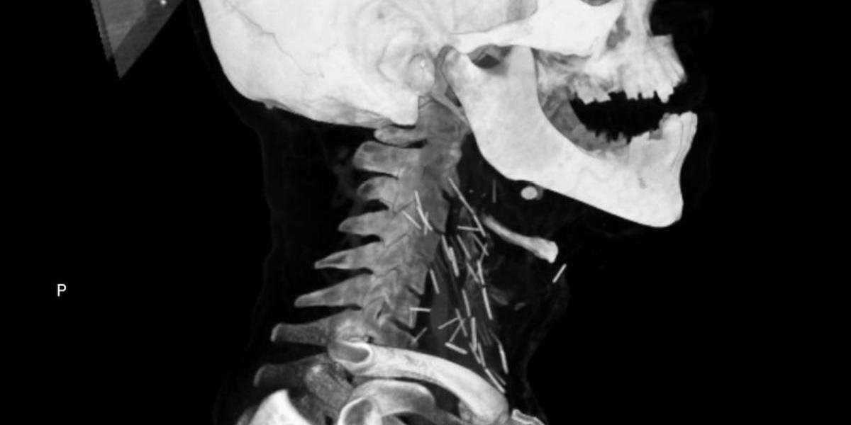 FOTO Desivý röntgen narkomana: Žil s desiatkami zlomených ihiel v krku