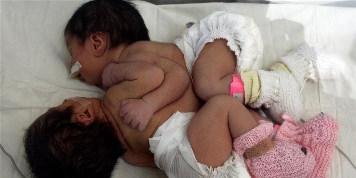 V Gaze sa narodili siamské dvojčatá, potrebujú komplikovaný zákrok