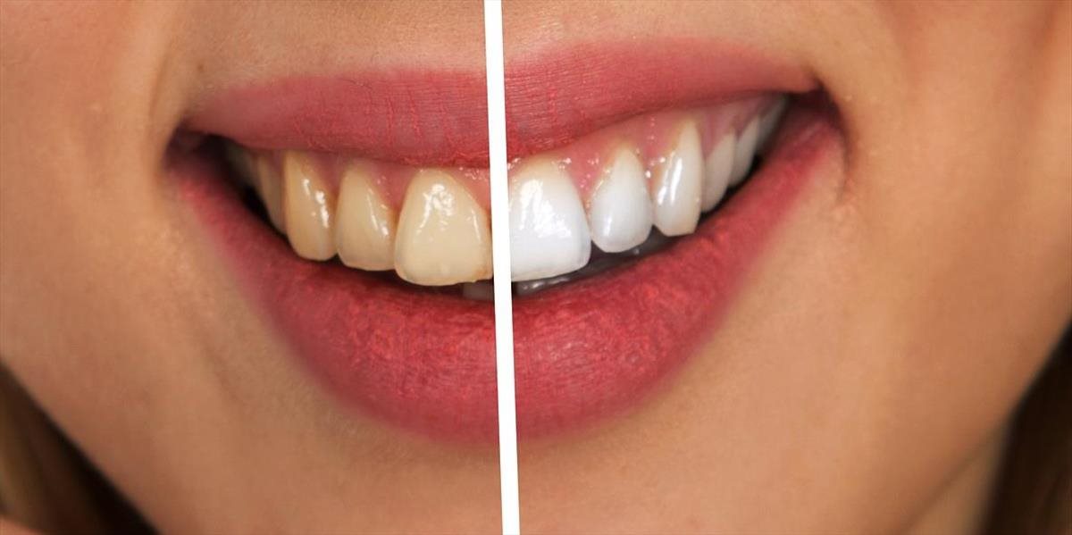 Triky, ako mať perfektne vyzerajúce zuby! Na čo si dať pozor a ako ich prirodzene vybieliť?