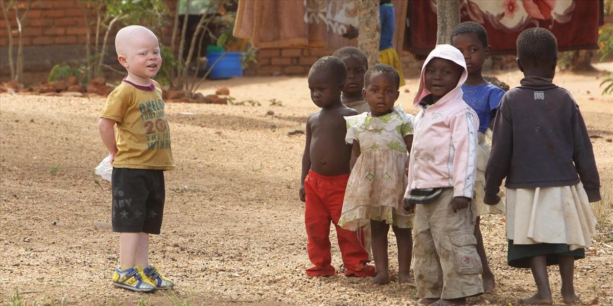 OSN vyhlásila 13. jún za Medzinárodný deň povedomia o albinizme (infomateriál)