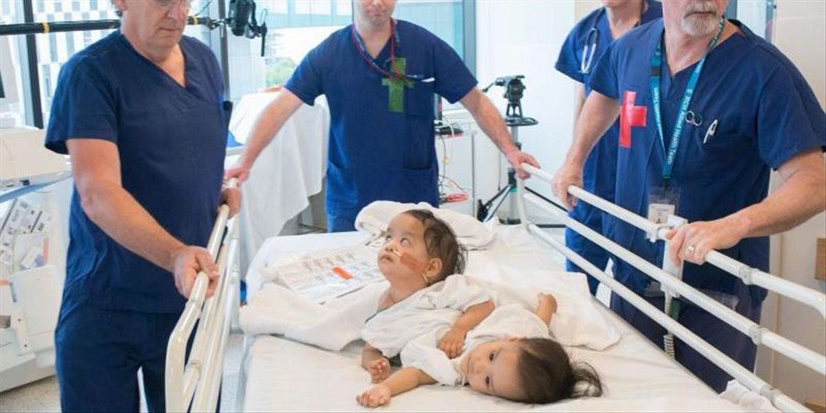 Náročná operácia: Chirurgovia v Melbourne oddelili siamské dvojičky, na ktorých operáciu sa vyzbieral celý svet