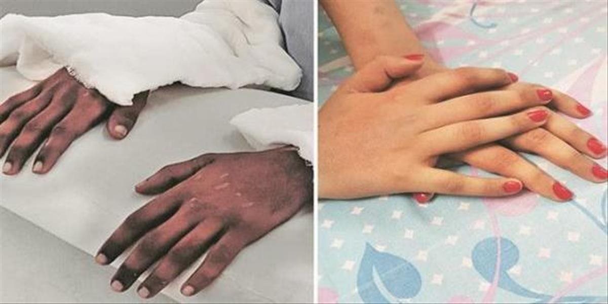 Dievčaťu transplantovali ruky, tie následne zmenili farbu