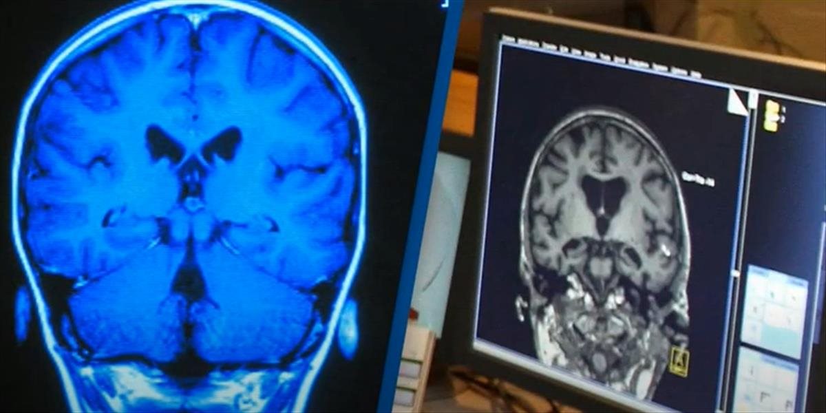 Umelá inteligencia dokáže diagnostikovať demenciu za jeden deň