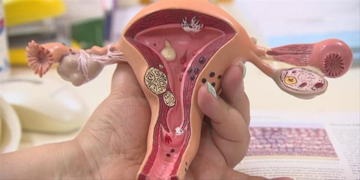 Ženy podceňujú návštevy gynekológa. Rezort zdravotníctva spúšťa skríning rakoviny krčka maternice