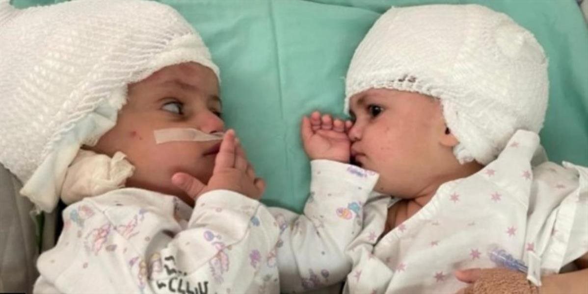 VIDEO: Izraelskí lekári oddelili dvojčatá zrastené hlavami!