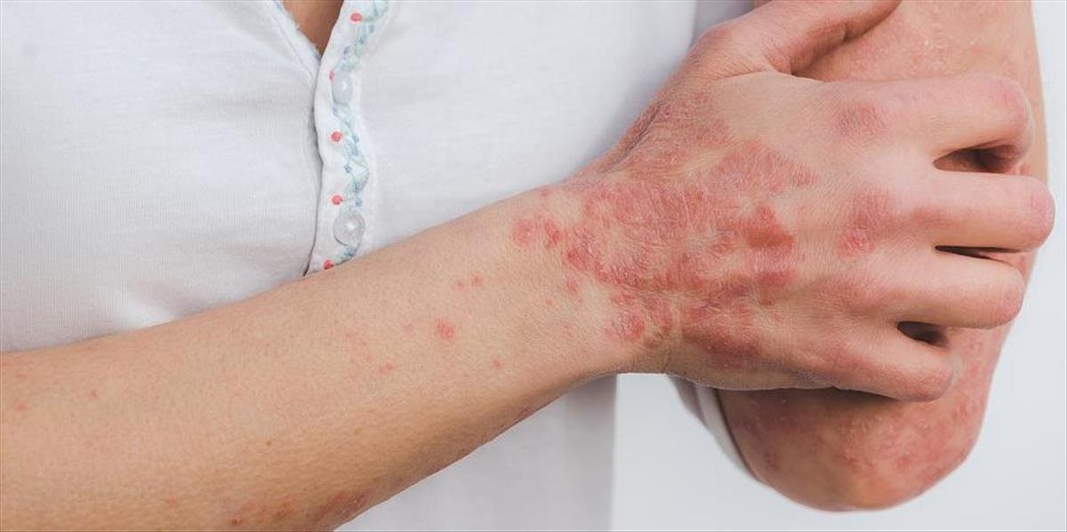ZDRAVIE Psoriáza – choroba, ktorá stigmatizuje telo i dušu