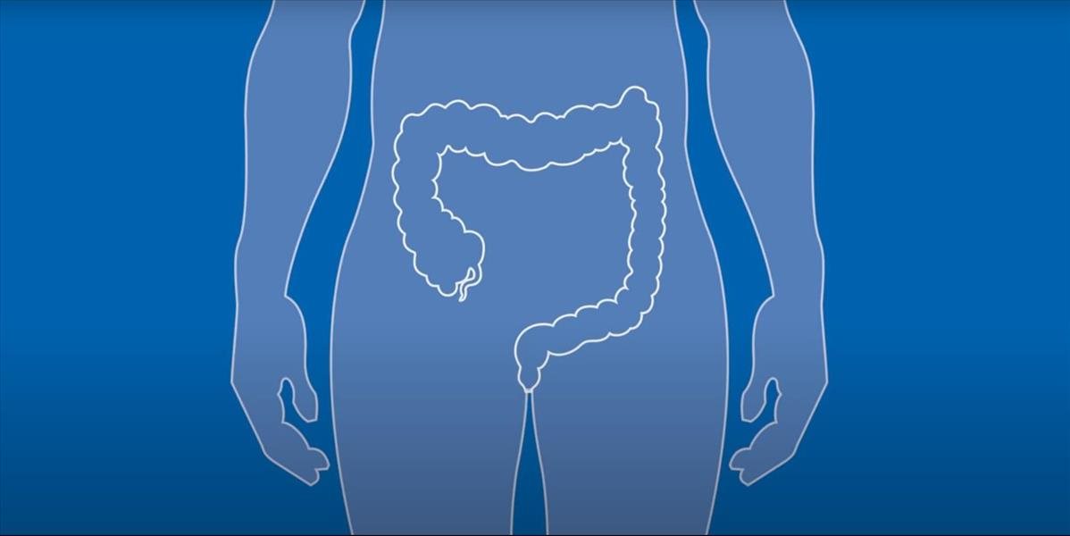 Rakovine hrubého čreva a konečníka sa dá predísť, dôležitá je prevencia