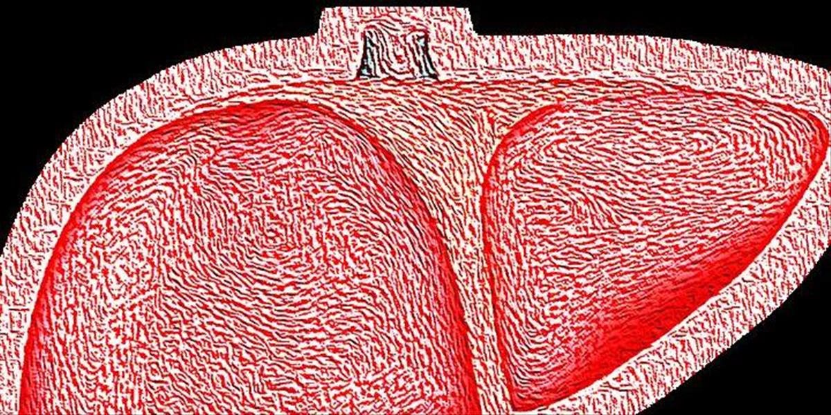 ZDRAVIE Najčastejšou príčinou smrti dospelých na Slovensku je choroba pečene – cirhóza