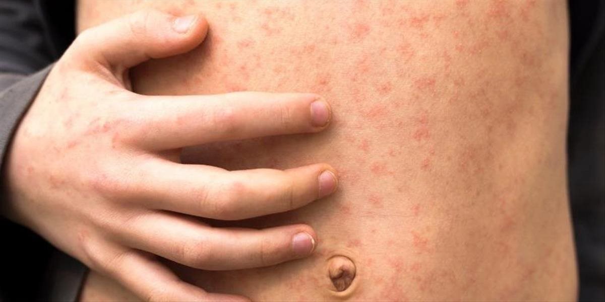 Podľa WHO a CDC predstavujú osýpky bezprostrednú hrozbu