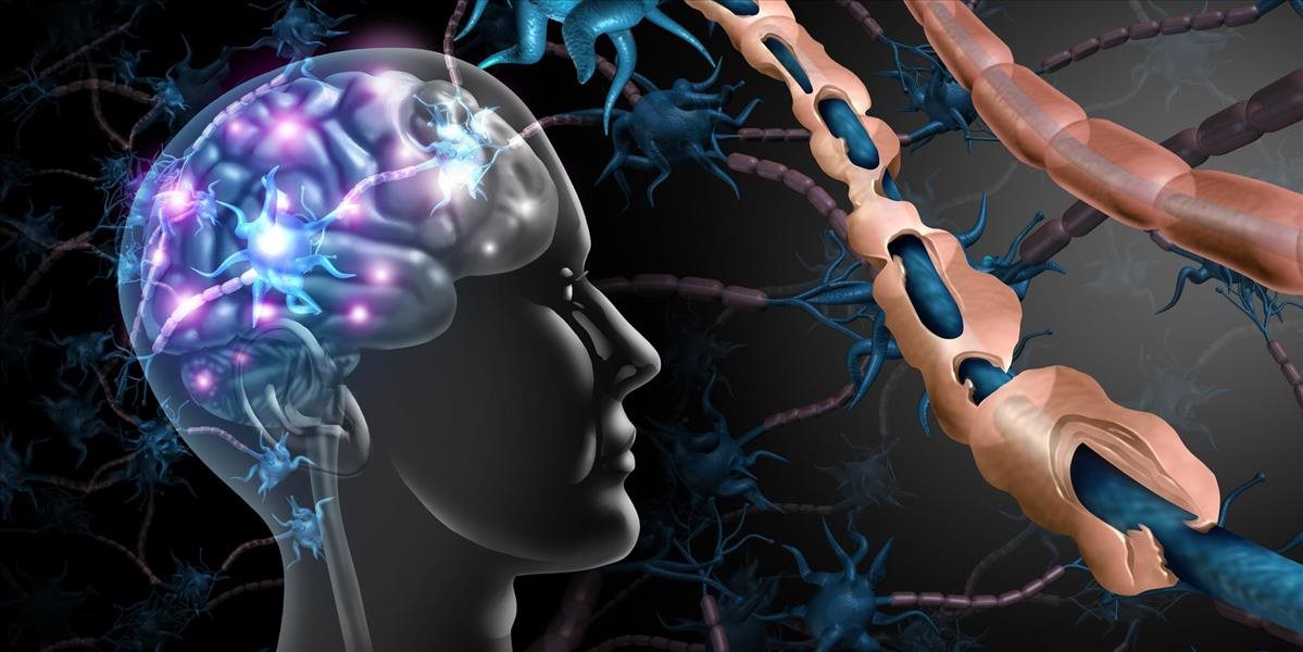 Sklerózu multiplex denne diagnostikujú takmer šiestim Slovákom