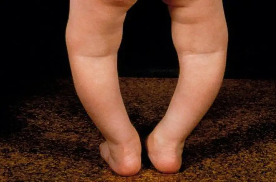 V Škótsku sú na vzostupe tzv. viktoriánske choroby, najmä krivica