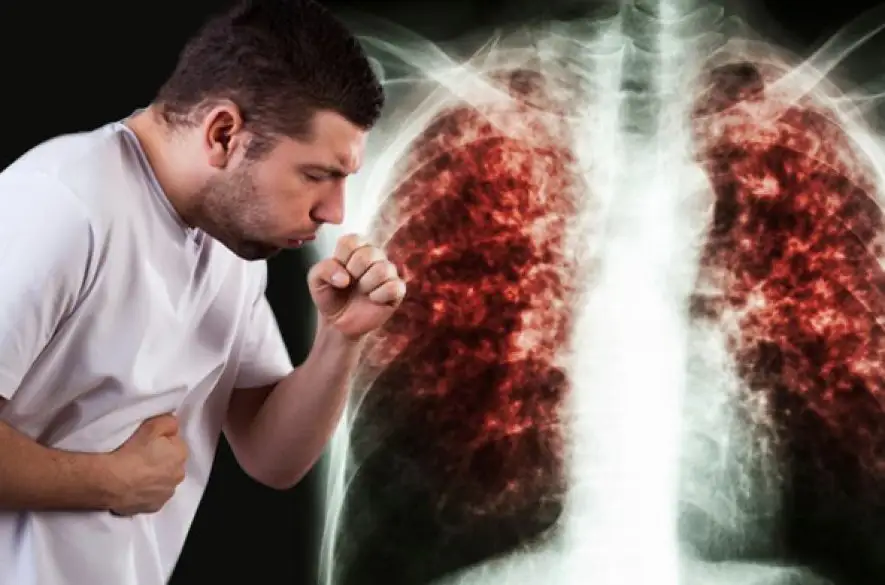 Blíži sa Svetový deň boja proti tuberkulóze. Aká je situácia tuberkulózy na Slovensku?