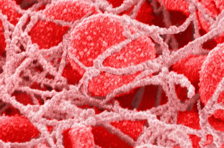 Mikroplasty sa našli v krvných zrazeninách v srdci, mozgu a nohách